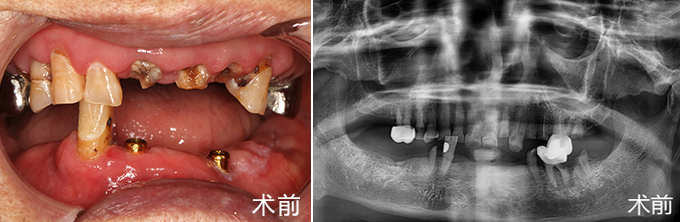 种植牙术前照片和牙片