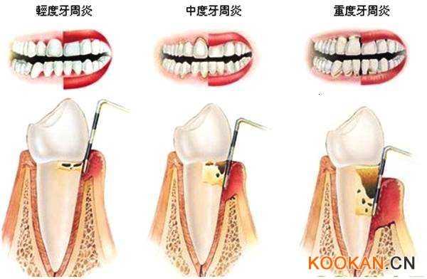 牙周炎的三个阶段