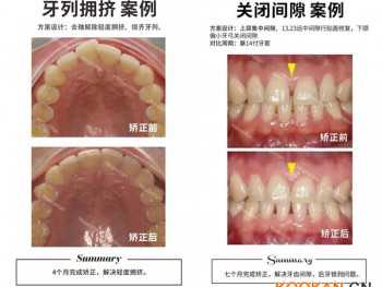 这样的牙齿都适合用易齐微矫正